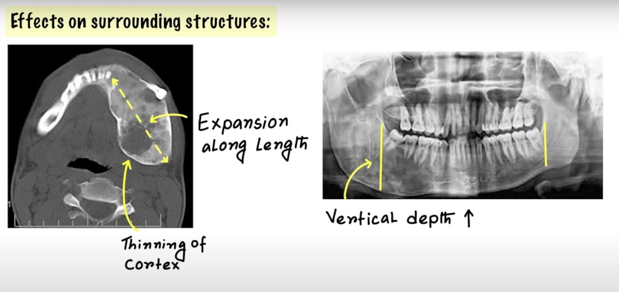 Fibrous Dysplasia Radiology Dental Notes Medinaz Blog