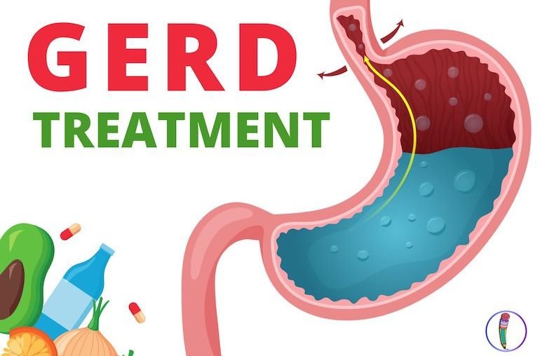 GERD Home Remedy All You Need To Know