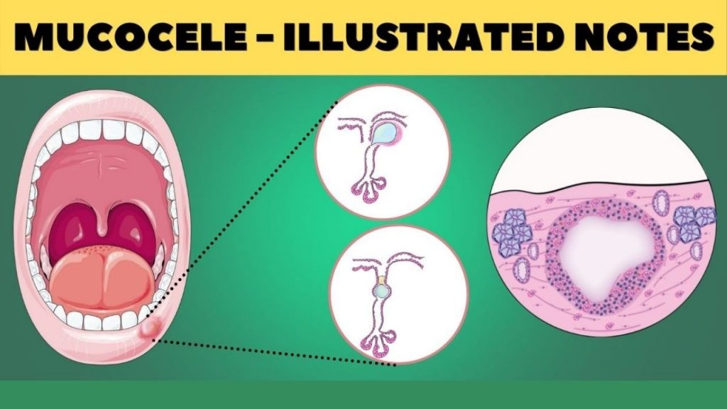 Oral Mucocele Illustrated High Yield Dental Notes Medinaz