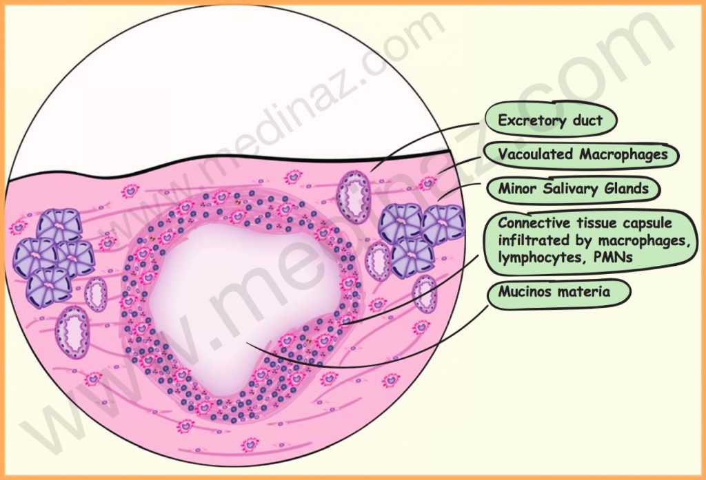 mucocele histology