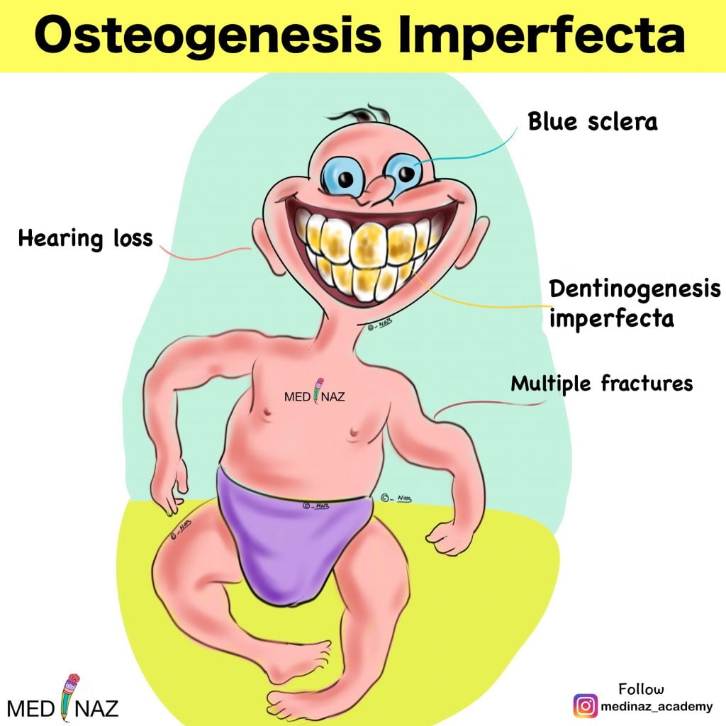 Osteogenesis imperfecta visual mnemonic