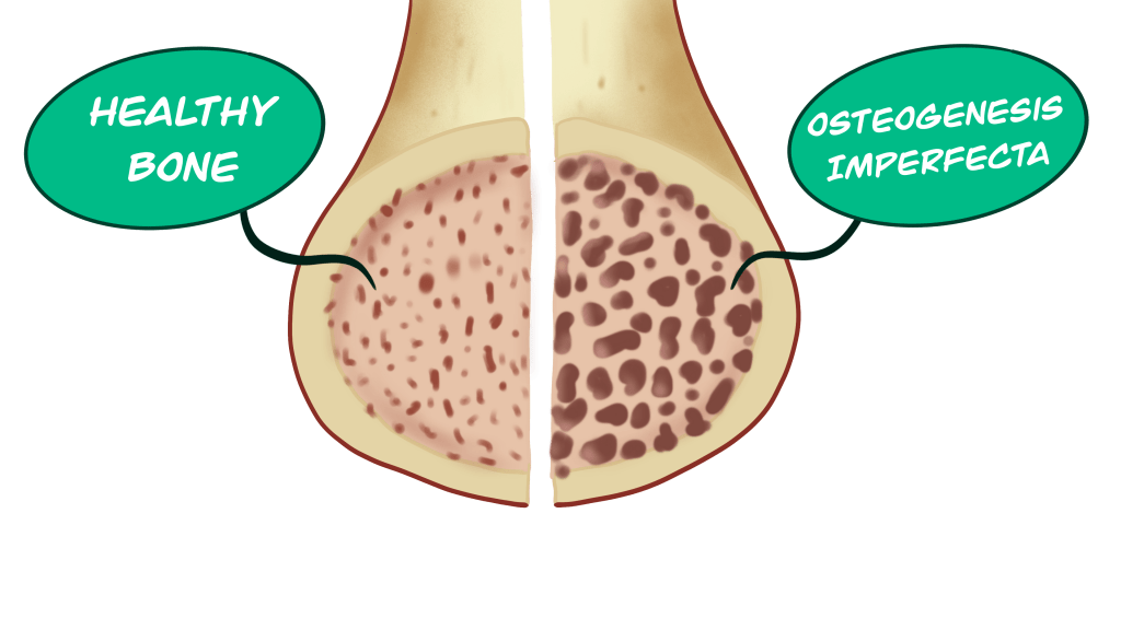 osteogenesis imperfecta bone changes