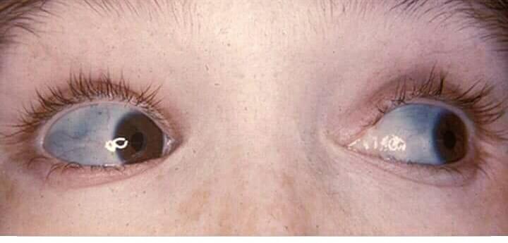 blue sclera