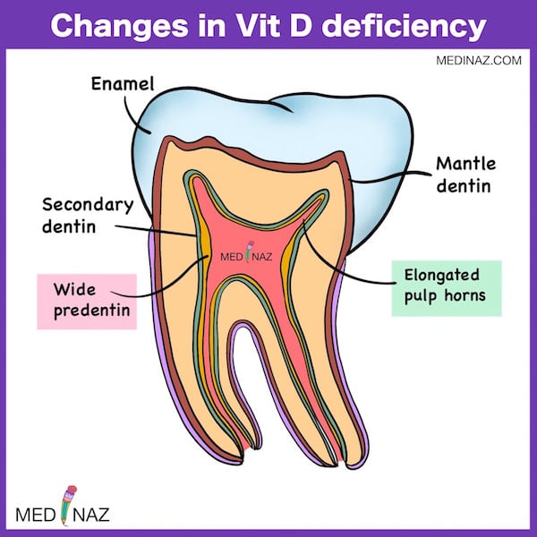 Tooth Changes in Vit D deficiency