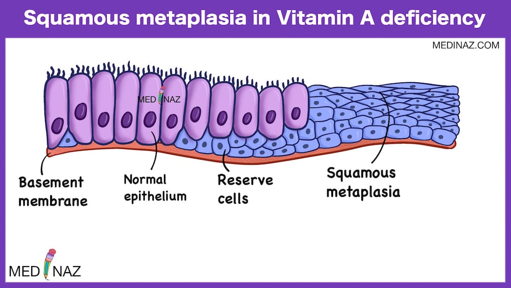  Squamous metaplasia in Vitamin A deficiency