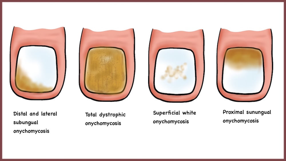 Onychomycosis types