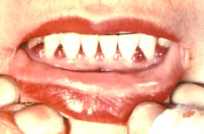 niacin deficiency tongue