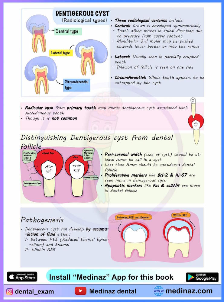 Dentigerous Cyst Radiological features