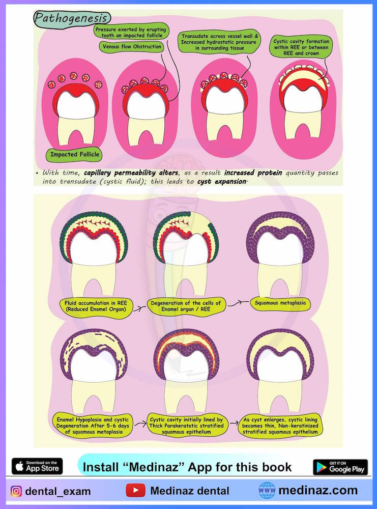 Cyst Pathogenesis