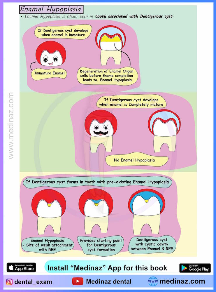 ANGLE'S CLASSIFICATION MALOCCLUSION - Dental Notes