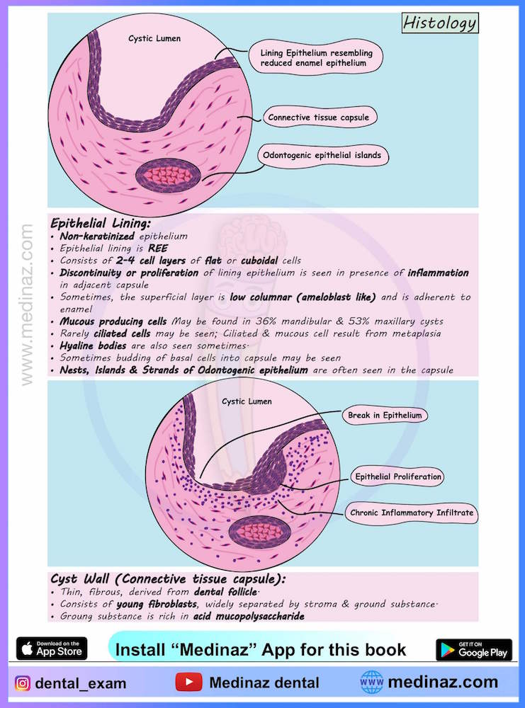 Dentigerous Cyst Oral Pathology Notes - Medinaz Blog