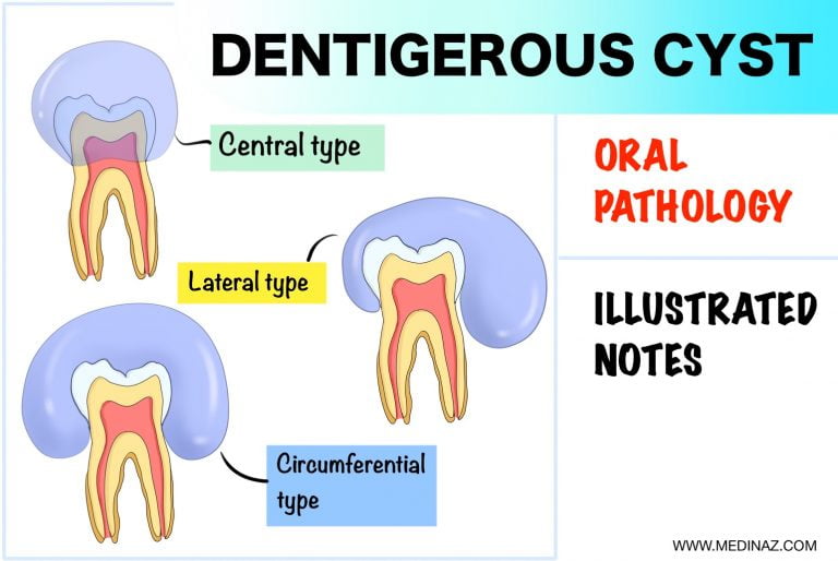 Dentigerous Cyst Oral Pathology Notes Medinaz Blog 7404