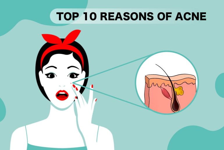 Top 10 causes of Acne