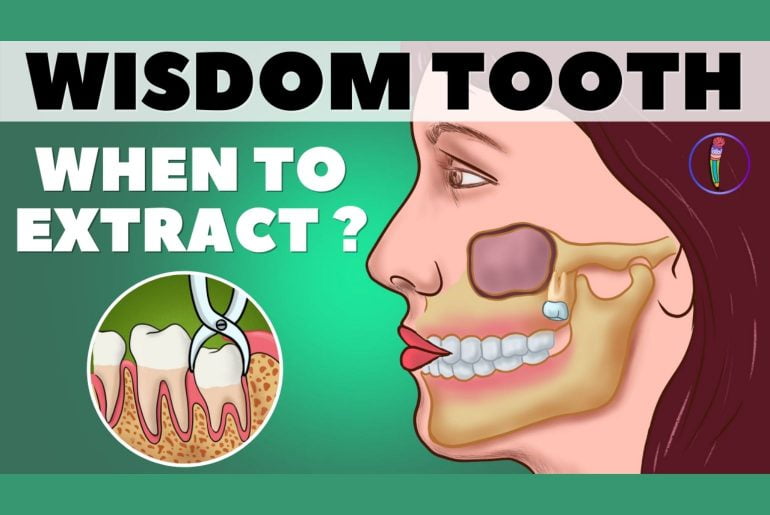 Wisdom teeth removal