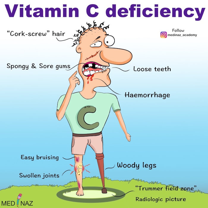 Vitamin C deficiency Signs & Symptoms