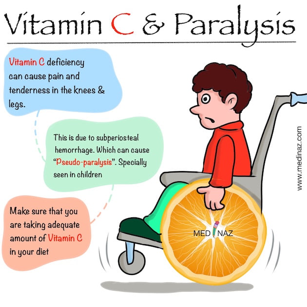 Vitamin C deficiency in Child
