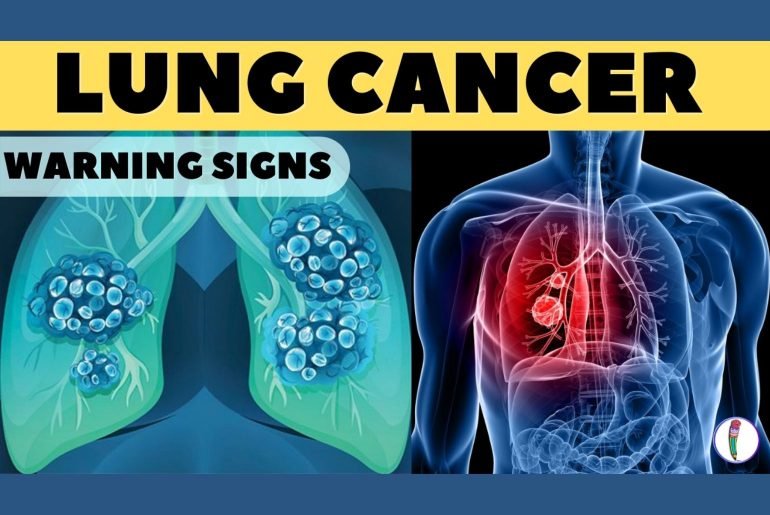 Lung cancer warning signs