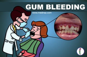 Gum bleeding