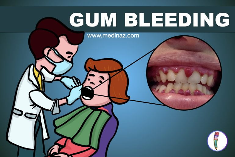 Gum bleeding