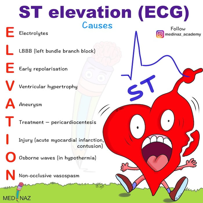 ST-segment-elevation-mnemonic