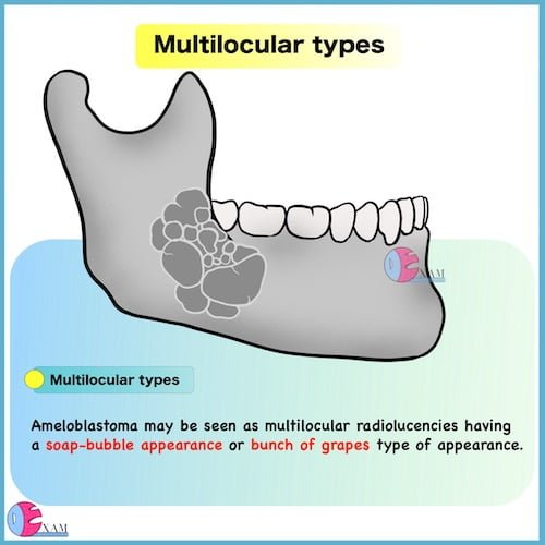 Ameloblastoma Radiology Multilocular type