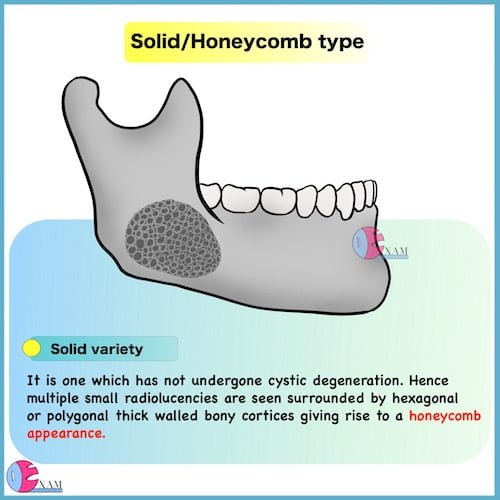 Ameloblastoma Radiology Solid variety