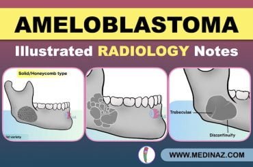 Ameloblastoma Radiology