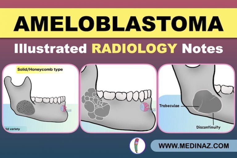 Ameloblastoma Radiology: Dental Radiology Notes