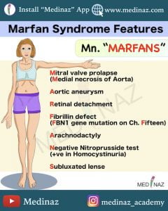Marfan syndrome Mnemonic: For USMLE, NEET PG, FMGE
