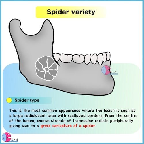 Spider variety Ameloblastoma