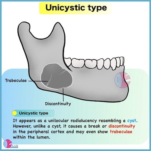 Ameloblastoma Radiology: Dental Radiology Notes 