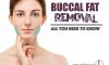 Buccal Fat removal – All You Need to Know