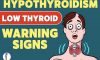 10 Hypothyroidism Symptoms & Signs