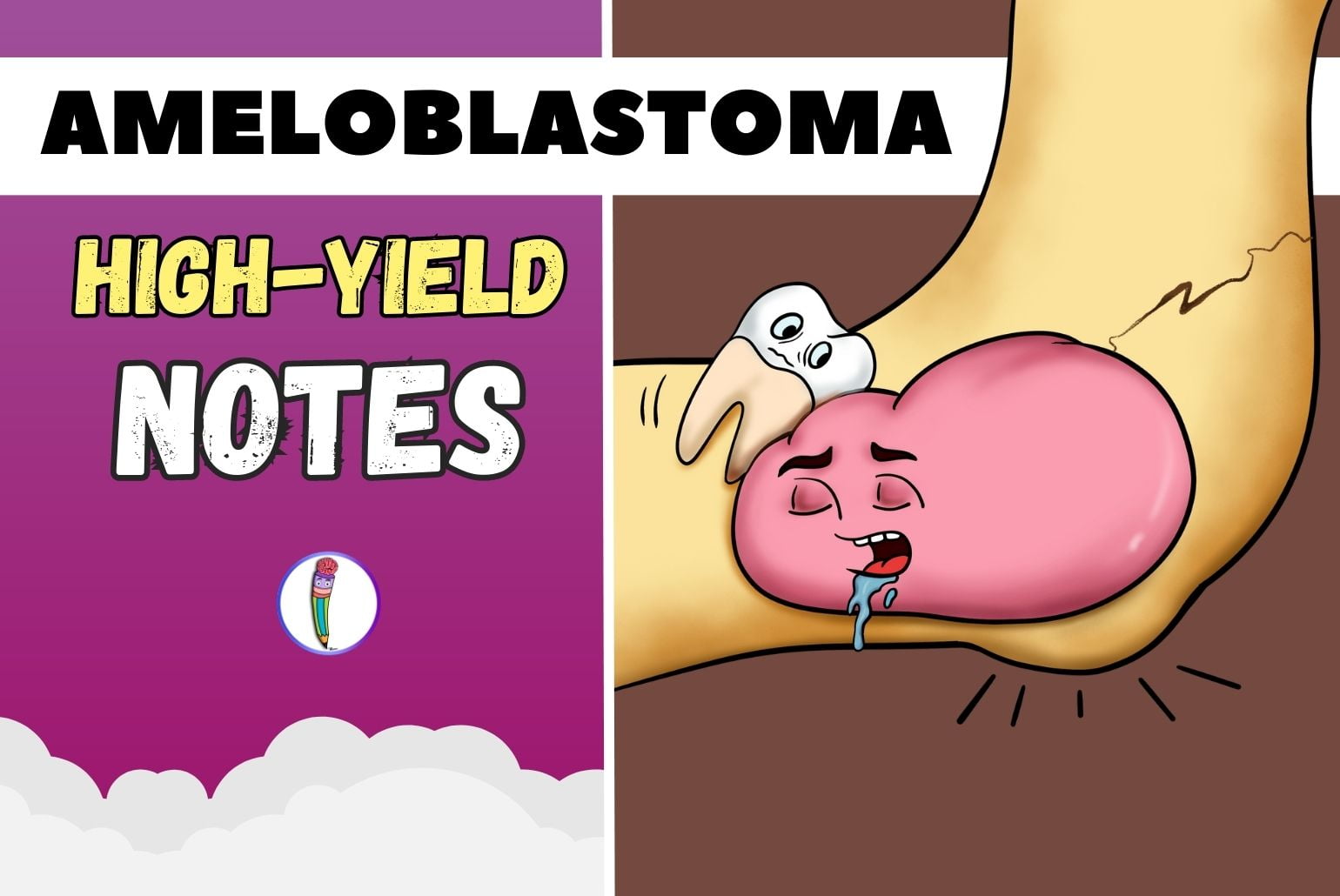 Ameloblastoma Highyield Notes