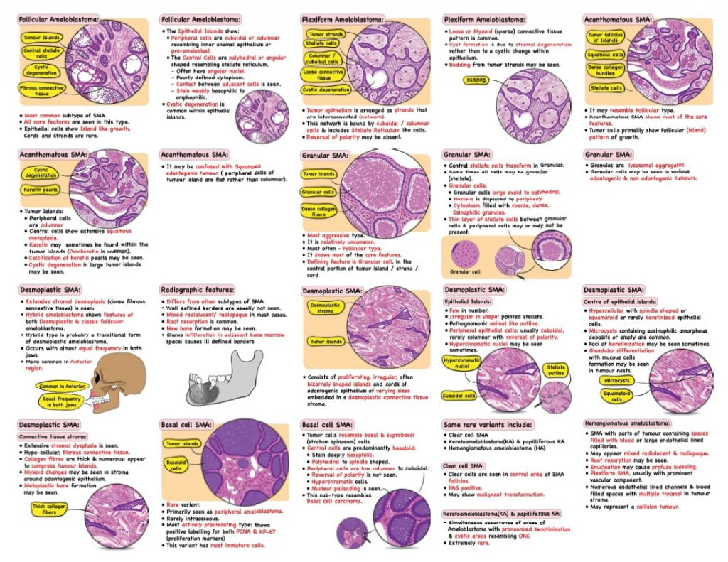Ameloblastoma Notes 3