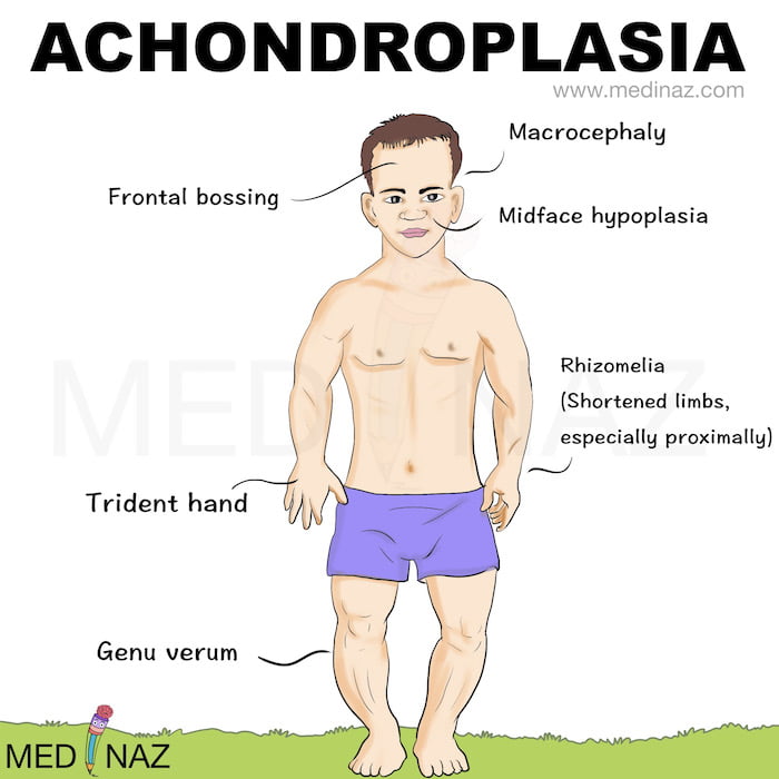 Achondroplasia clinical features