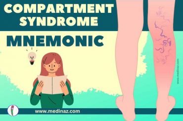 Compartment Syndrome Mnemonic