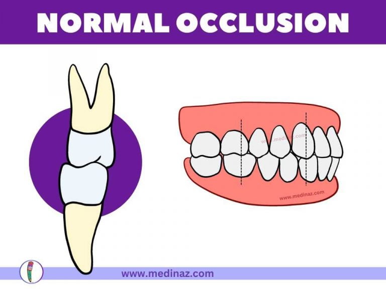 ANGLE’S CLASSIFICATION MALOCCLUSION Dental Notes
