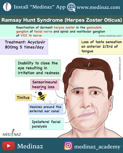 Ramsay Hunt Syndrome Visual Mnemonic