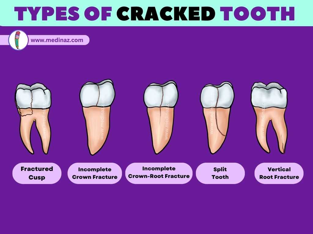 TYPES OF CRACKED TOOTH
