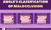 ANGLE’S CLASSIFICATION MALOCCLUSION – Dental Notes