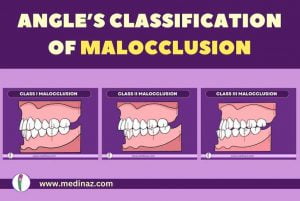 ANGLE’S CLASSIFICATION MALOCCLUSION - Dental Notes