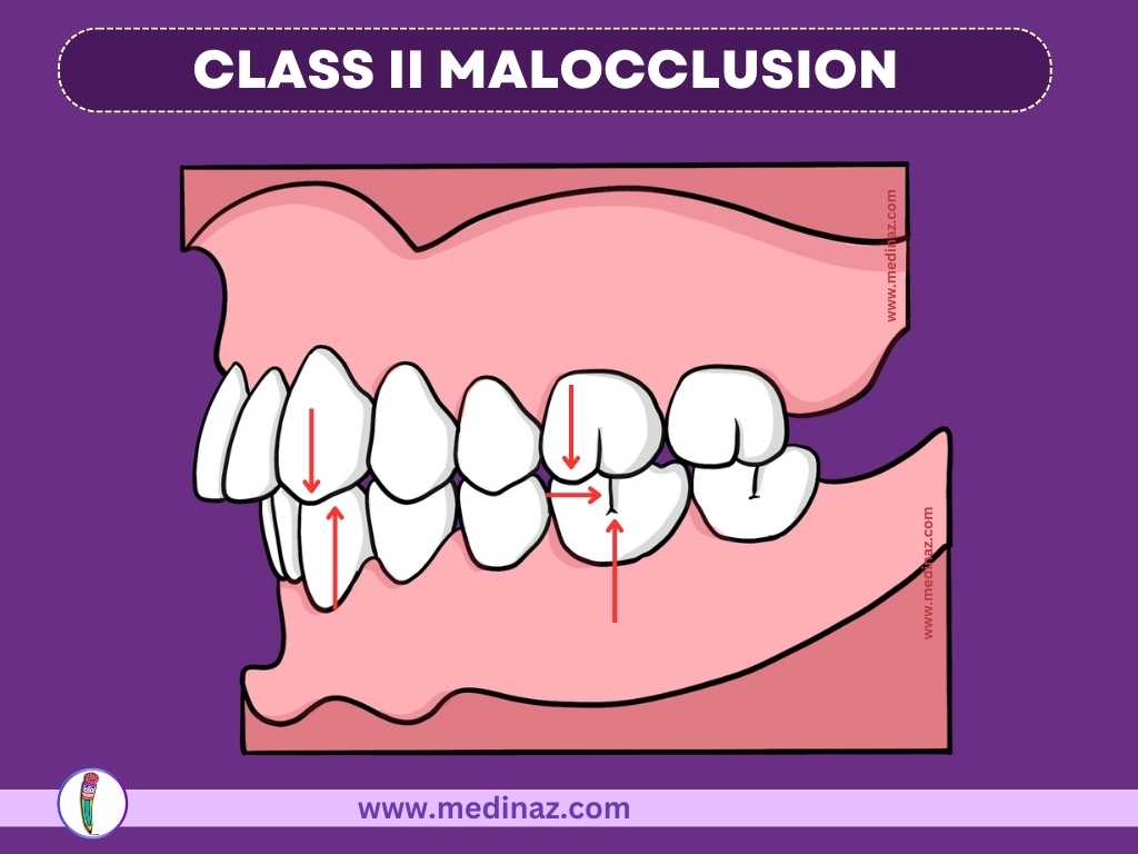 CLASS II MALOCCLUSION