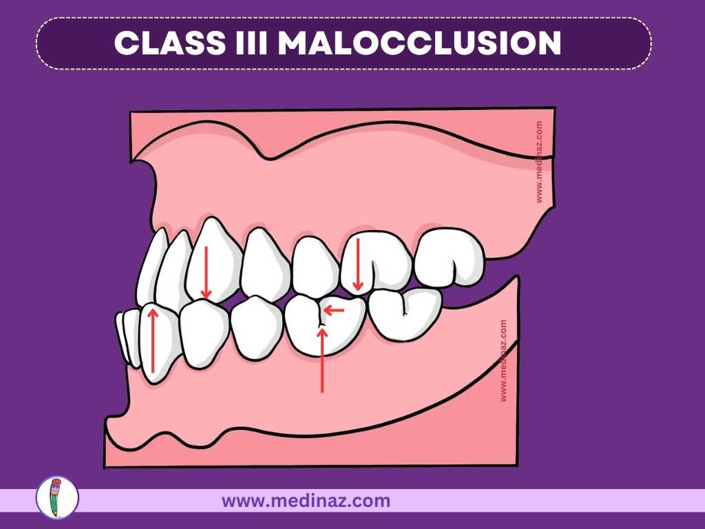 CLASS III MALOCCLUSION