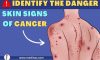 Lesions on Skin from Cancer – Understand the Danger
