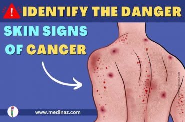 Lesions on Skin from Cancer - Understand the Danger