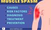 Muscle Spasms: The Ultimate Guide