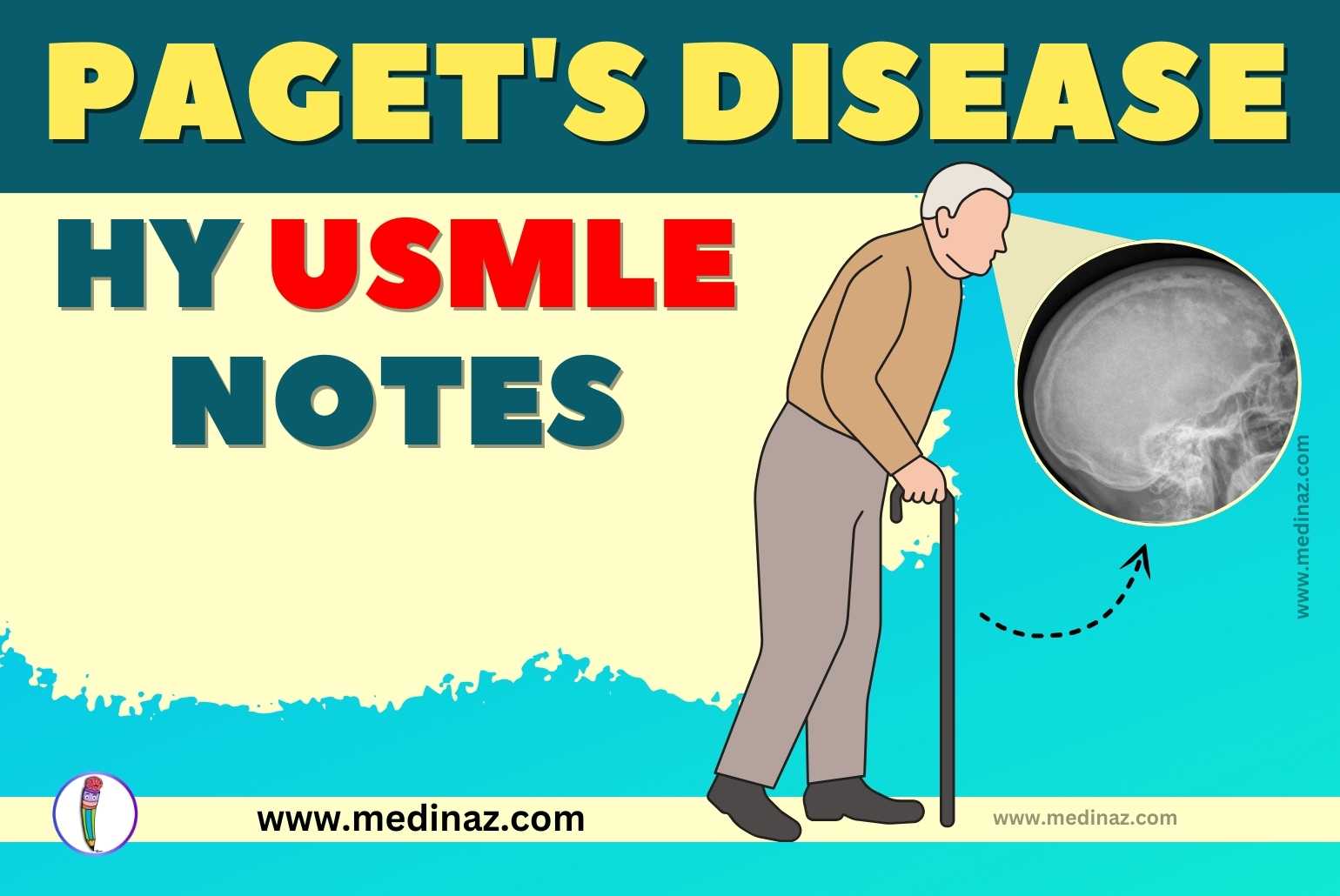 Paget's Disease USMLE Notes