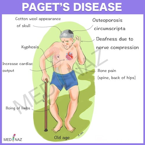 Pagets disease visual mnemonic