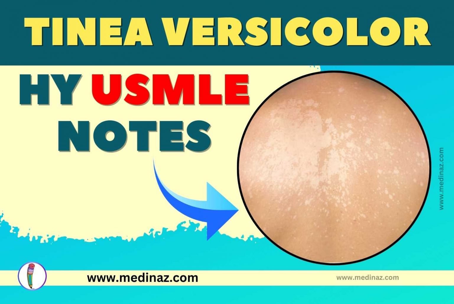 Tinea Versicolor USMLE Notes